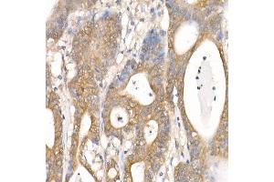 Immunohistochemistry of paraffin-embedded Human colon carcinoma using β-Catenin antibody (ABIN7266138) at dilution of 1:100 (40x lens).