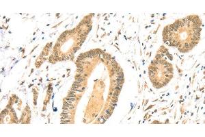Immunohistochemistry of paraffin-embedded Human colon cancer using TSPAN13 Polyclonal Antibody at dilution of 1:35 (TSPAN13 anticorps)