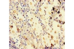 Immunohistochemistry of paraffin-embedded human lung cancer using ABIN7171269 at dilution of 1:100 (STXBP6 anticorps  (AA 2-210))