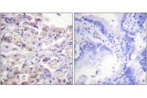 Immunohistochemistry analysis of paraffin-embedded human lung carcinoma, using hnRPD (Phospho-Ser83) Antibody. (HNRNPD/AUF1 anticorps  (pSer83))
