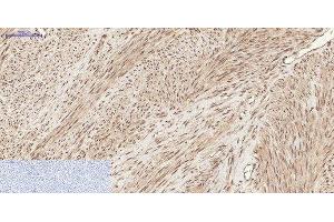 Immunohistochemistry of paraffin-embedded Human uterus tissue using Phospho-CHEK2 (Thr68) Polyclonal Antibody at dilution of 1:200 (CHEK2 anticorps  (pThr68))