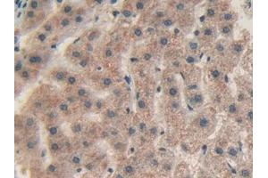 Detection of CHI3L1 in Human Liver cancer Tissue using Polyclonal Antibody to Chitinase-3-like Protein 1 (CHI3L1) (CHI3L1 anticorps  (AA 112-377))