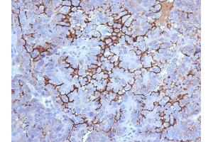 Formalin-fixed, paraffin-embedded human Ovarian Carcinoma stained with MUC16 Mouse Monoclonal Antibody (5E11). (MUC16 anticorps)