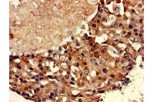 Immunohistochemistry of paraffin-embedded human breast cancer using ABIN7171581 at dilution of 1:100 (TBP anticorps  (AA 1-55))