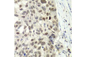 Immunohistochemistry of paraffin-embedded human esophageal cancer using E2F6 antibody (ABIN6290326) at dilution of 1:100 (40x lens).