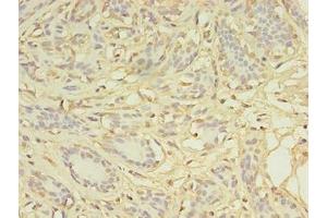 Immunohistochemistry of paraffin-embedded human breast cancer using ABIN7149384 at dilution of 1:100 (AGBL2 anticorps  (AA 10-270))