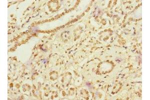 Immunohistochemistry of paraffin-embedded human pancreatic cancer using ABIN7167094 at dilution of 1:100 (RanBP3 anticorps  (AA 1-250))