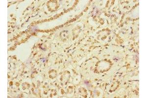 Immunohistochemistry of paraffin-embedded human pancreatic cancer using ABIN7167094 at dilution of 1:100