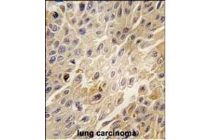 Formalin-fixed and paraffin-embedded human lung carcinoma tissue reacted with GRK2 Antibody (C-term) (ABIN1882061 and ABIN2841168) , which was peroxidase-conjugated to the secondary antibody, followed by DAB staining.