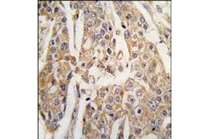 Formalin-fixed and paraffin-embedded human breast carcinoma tissue reacted with PKM2 antibody (C-term), which was peroxidase-conjugated to the secondary antibody, followed by DAB staining. (PKM2 anticorps  (C-Term))