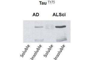 Western blot detection of insoluble phospho-Tau protein using the anti-Tau (Thr-175) antibody in samples isolated from patients with a neurodegenerative disease (Amyotropic lateral sclerosis, ALS or Alzheimer’s disease, AD (tau anticorps  (pThr175))