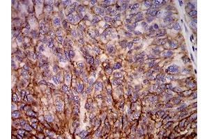 Immunohistochemical analysis of paraffin-embedded ovarian cancer tissues using HLA-B mouse mAb with DAB staining.