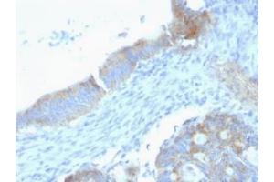 Formalin-fixed, paraffin-embedded human testicular carcinoma stained with anti-Perlecan antibody (SPM255).