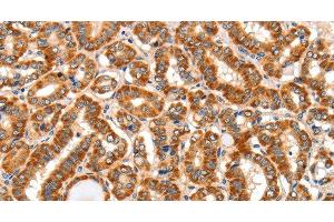 Immunohistochemistry of paraffin-embedded Human thyroid cancer tissue using AIM2 Polyclonal Antibody at dilution 1:60 (AIM2 anticorps)