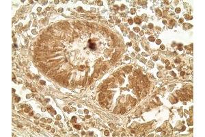Immunohistochemistry analysis of human colon tumor tissue using Glucagon like peptide 1 pAb,  at a dilution of 1:500. (GLP-1 anticorps  (AA 1-19))