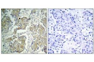 Immunohistochemical analysis of paraffin-embedded human breast carcinoma tissue using VEGFR2(Phospho-Tyr1214) Antibody(left) or the same antibody preincubated with blocking peptide(right).