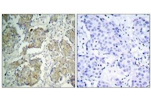 Immunohistochemical analysis of paraffin-embedded human breast carcinoma tissue using VEGFR2(Phospho-Tyr1214) Antibody(left) or the same antibody preincubated with blocking peptide(right). (VEGFR2/CD309 anticorps  (pTyr1214))