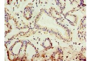 Immunohistochemistry of paraffin-embedded human breast cancer using ABIN7157726 at dilution of 1:100