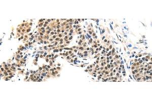 Immunohistochemistry of paraffin-embedded Human liver cancer tissue using MAGEA6 Polyclonal Antibody at dilution 1:120 (MAGEA6 anticorps)