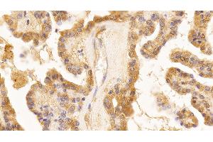 Detection of LMNB1 in Human Thyroid cancer Tissue using Anti-Lamin B1 (LMNB1) Monoclonal Antibody