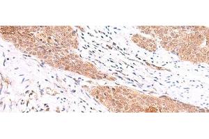 Immunohistochemistry of paraffin-embedded Human esophagus cancer tissue using COPS3 Polyclonal Antibody at dilution of 1:60(x200)