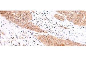 Immunohistochemistry of paraffin-embedded Human esophagus cancer tissue using COPS3 Polyclonal Antibody at dilution of 1:60(x200) (COPS3 anticorps)