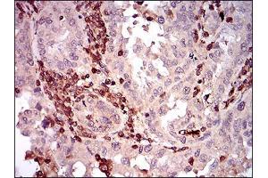 Immunohistochemical analysis of paraffin-embedded endometrial cancer tissues using CD68 mouse mAb with DAB staining. (CD68 anticorps  (AA 42-155))