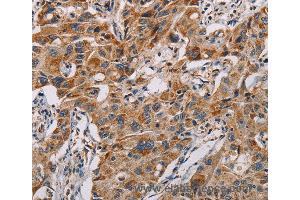 Immunohistochemistry of Human lung cancer using MMP1 Polyclonal Antibody at dilution of 1:60 (MMP1 anticorps)