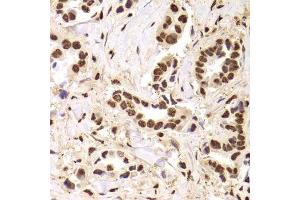 Immunohistochemistry of paraffin-embedded human breast cancer using ANP32A Antibody.