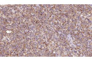 ABIN6273184 at 1/100 staining Human lymph cancer tissue by IHC-P.