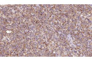 ABIN6273184 at 1/100 staining Human lymph cancer tissue by IHC-P. (SLC22A12 anticorps)