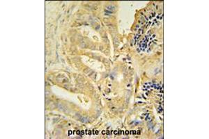 TLL1 antibody immunohistochemistry analysis in formalin fixed and paraffin embedded human prostate carcinoma followed by peroxidase conjugation of the secondary antibody and DAB staining. (TLL1 anticorps  (C-Term))