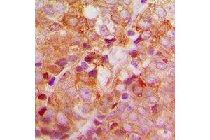 Immunohistochemical analysis of ACBD6 staining in human breast cancer formalin fixed paraffin embedded tissue section. (ACBD6 anticorps)