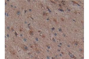 Detection of CS in Human Glioma Tissue using Polyclonal Antibody to Citrate Synthase (CS)