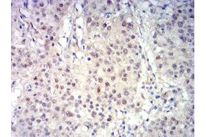 Immunohistochemical analysis of paraffin-embedded stomach cancer tissues using BCL11B mouse mAb with DAB staining.
