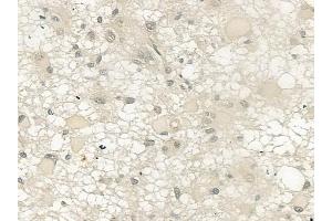 ABIN6257759 and ABIN6274371 at 1/100 staining human astrocytoma by IHC-P. (MED1 anticorps  (C-Term))