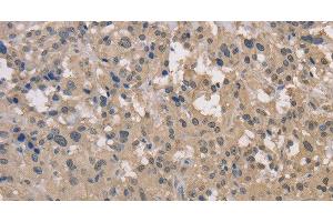 Immunohistochemistry of paraffin-embedded Human thyroid cancer using DRG1 Polyclonal Antibody at dilution of 1:30 (DRG1 anticorps)