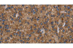 Immunohistochemistry of paraffin-embedded Human liver cancer tissue using NECTIN2 Polyclonal Antibody at dilution 1:40 (PVRL2 anticorps)