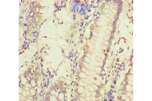 Immunohistochemistry of paraffin-embedded human colon cancer using ABIN7159632 at dilution of 1:100 (MCCC1 anticorps  (AA 526-725))