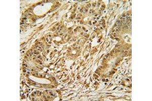 MCM2 antibody immunohistochemistry analysis in formalin fixed and paraffin embedded human colon carcinoma.