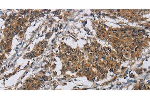 Immunohistochemistry of paraffin-embedded Human gastric cancer tissue using Claudin 8 Polyclonal Antibody at dilution 1:50
