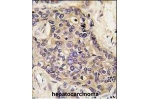Formalin-fixed and paraffin-embedded human hepatocarcinoma tissue reacted with HGF antibody (C-term) (ABIN388462 and ABIN2848889) , which was peroxidase-conjugated to the secondary antibody, followed by DAB staining. (HGF anticorps  (C-Term))
