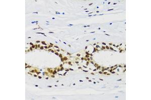 Immunohistochemistry of paraffin-embedded human breast cancer using CIRBP antibody (ABIN6129747, ABIN6138627, ABIN6138629 and ABIN6221699) at dilution of 1:100 (40x lens). (CIRBP anticorps  (AA 1-172))