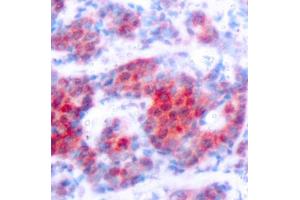 Immunohistochemistry of paraffin-embedded human breast carcinoma using Phospho-ST-Y693 antibody (ABIN3019610, ABIN3019611, ABIN3019612, ABIN1682083 and ABIN1682084). (STAT4 anticorps  (pTyr693))
