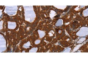 Immunohistochemistry of paraffin-embedded Human thyroid cancer tissue using PPP2R3C Polyclonal Antibody at dilution 1:30