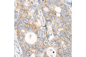 Immunohistochemistry of paraffin-embedded human colon carcinoma using MRP1/ antibody (ABIN7265736) at dilution of 1:100 (40x lens). (ABCC1 anticorps)