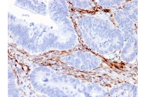 Formalin-fixed, paraffin-embedded human Colon Carcinoma stained with Nestin Mouse Monoclonal Antibody (NES/2911). (Nestin anticorps  (AA 698-844))