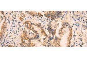 Immunohistochemistry of paraffin-embedded Human cervical cancer tissue using CRYM Polyclonal Antibody at dilution of 1:65(x200)