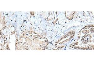 Immunohistochemistry of paraffin-embedded Human thyroid cancer tissue using SMC1A Polyclonal Antibody at dilution of 1:30(x200) (SMC1A anticorps)