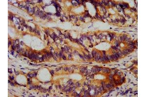 IHC image of ABIN7172763 diluted at 1:1000 and staining in paraffin-embedded human colon cancer performed on a Leica BondTM system.